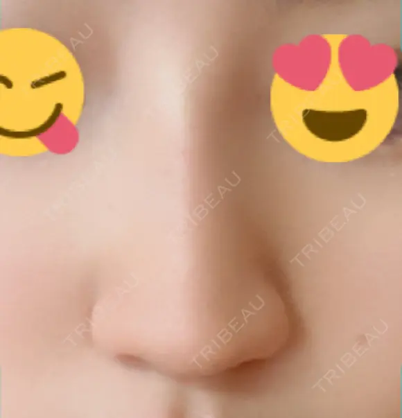 ヒアルロン酸注入（鼻） 新宿ビューティークリニック 新宿院 DAY 6 メイン用