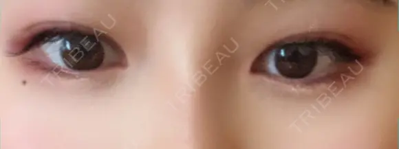 ヒアルロン酸注入（涙袋） 新宿ビューティークリニック 新宿院 DAY 6 メイン用