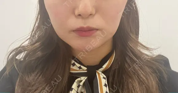 糸リフト 表参道スキンクリニック 表参道院 DAY 12 メイン用