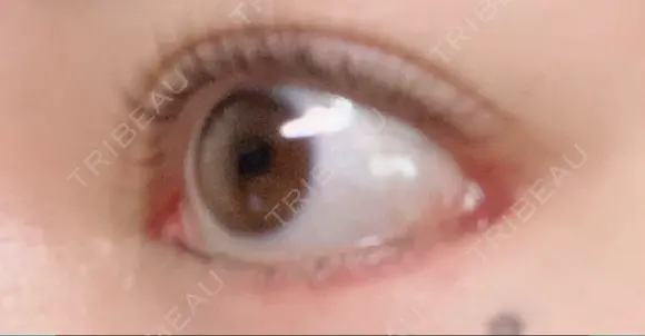 目尻靭帯移動 こいずみ形成クリニック名古屋 DAY 22 メイン用