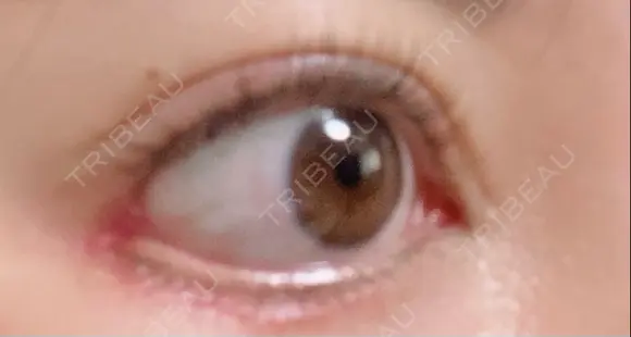 目尻靭帯移動 こいずみ形成クリニック名古屋 DAY 22 メイン用