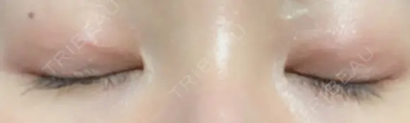 二重埋没 湘南美容クリニック 藤沢院 DAY 48 メイン用