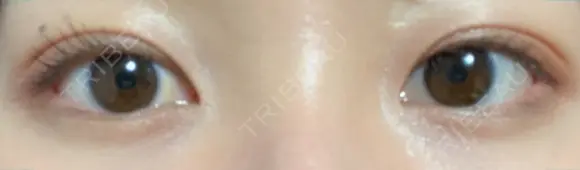 二重埋没 湘南美容クリニック 藤沢院 DAY 48 メイン用