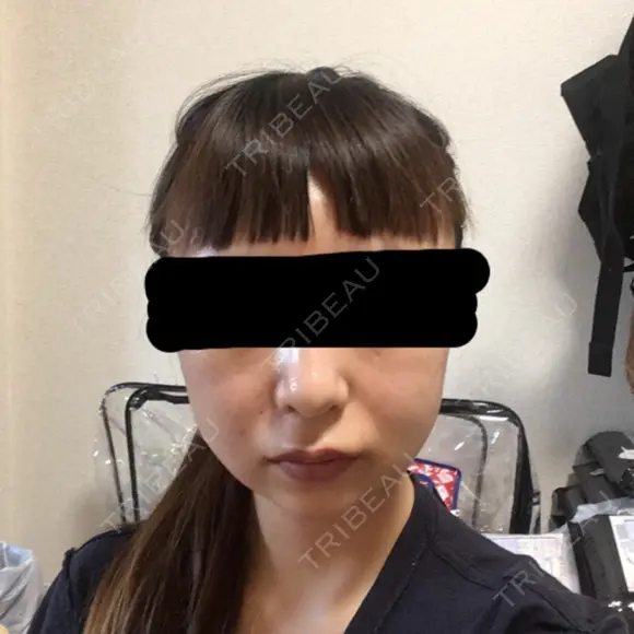 脂肪吸引（顔） / その他（輪郭） / 脂肪注入（輪郭） ヴィヴェンシアクリニック DAY 20 メイン用