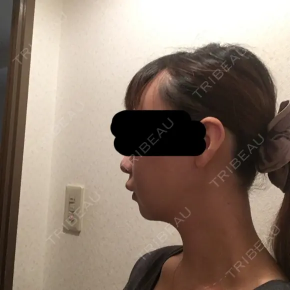 脂肪吸引（顔） / その他（輪郭） / 脂肪注入（輪郭） ヴィヴェンシアクリニック DAY 20 メイン用