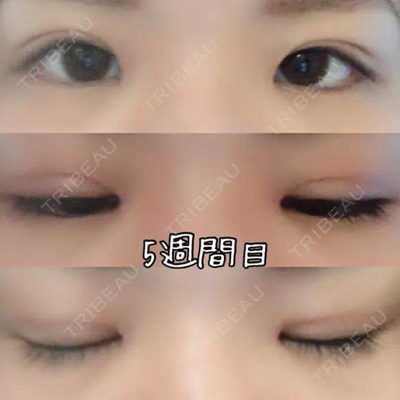 目頭切開 / 眼瞼下垂（切開） 白山クリニック 大分 AFTER メイン用