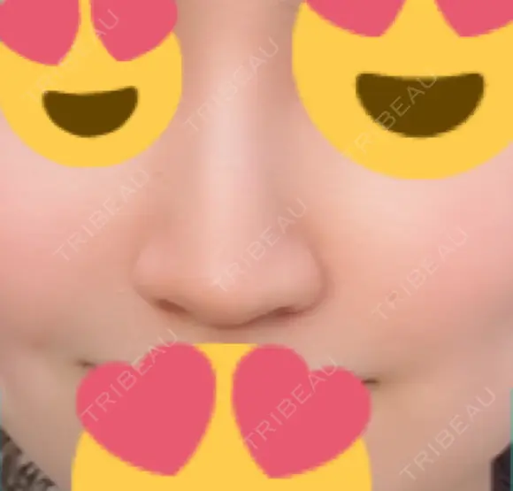 ヒアルロン酸注入（鼻） 新宿ビューティークリニック 新宿院 DAY 8 メイン用