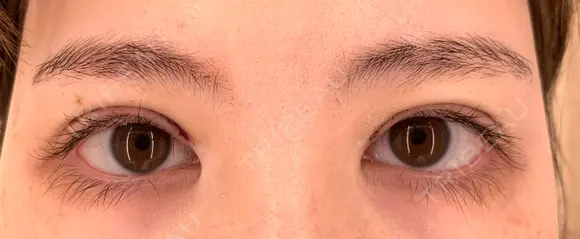 二重切開 オジスキンクリニック DAY 0 メイン用