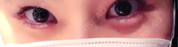 ヒアルロン酸注入（涙袋） 新宿ビューティークリニック 新宿院 DAY 8 メイン用