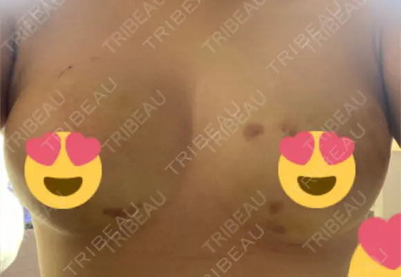 豊胸（脂肪注入） 湘南美容クリニック 新潟院 DAY 4 メイン用