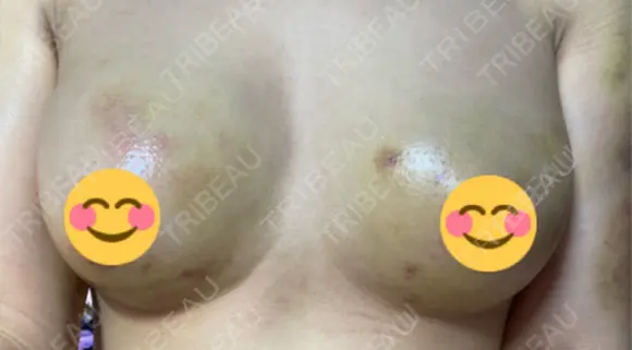 豊胸（脂肪注入） 湘南美容クリニック 新潟院 DAY 7 メイン用