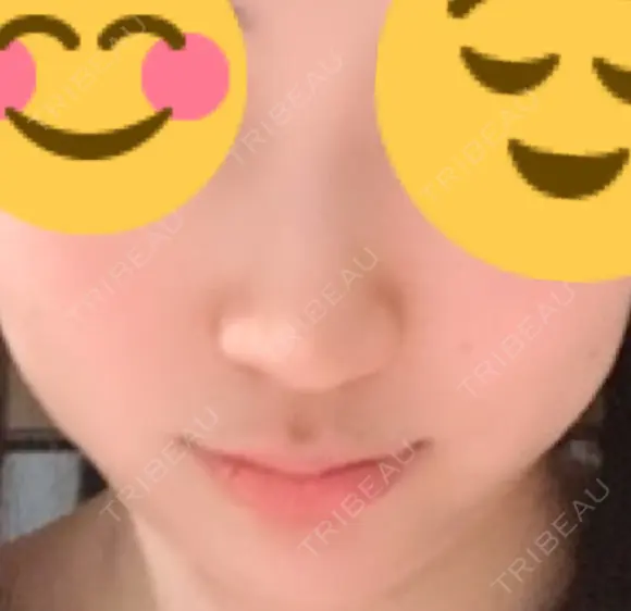 ヒアルロン酸注入（鼻） 新宿ビューティークリニック 新宿院 DAY 10 メイン用