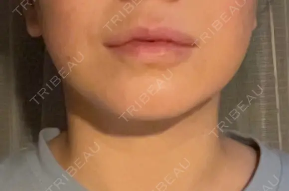 切開リフト / ボトックス（エラ・小顔） 石倉クリニック 水戸院 AFTER メイン用