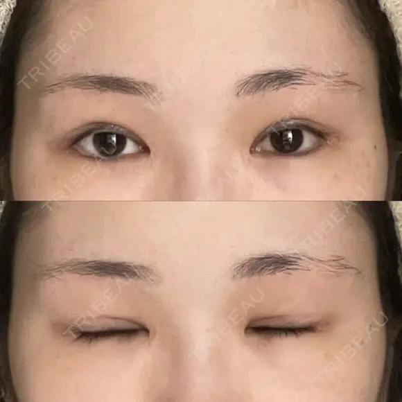 二重切開 / 目頭切開 / 眼瞼下垂（切開） / 上まぶたの脂肪取り 銀座マイアミ美容外科 DAY 93 メイン用