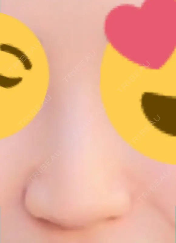 ヒアルロン酸注入（鼻） 新宿ビューティークリニック 新宿院 DAY 11 メイン用