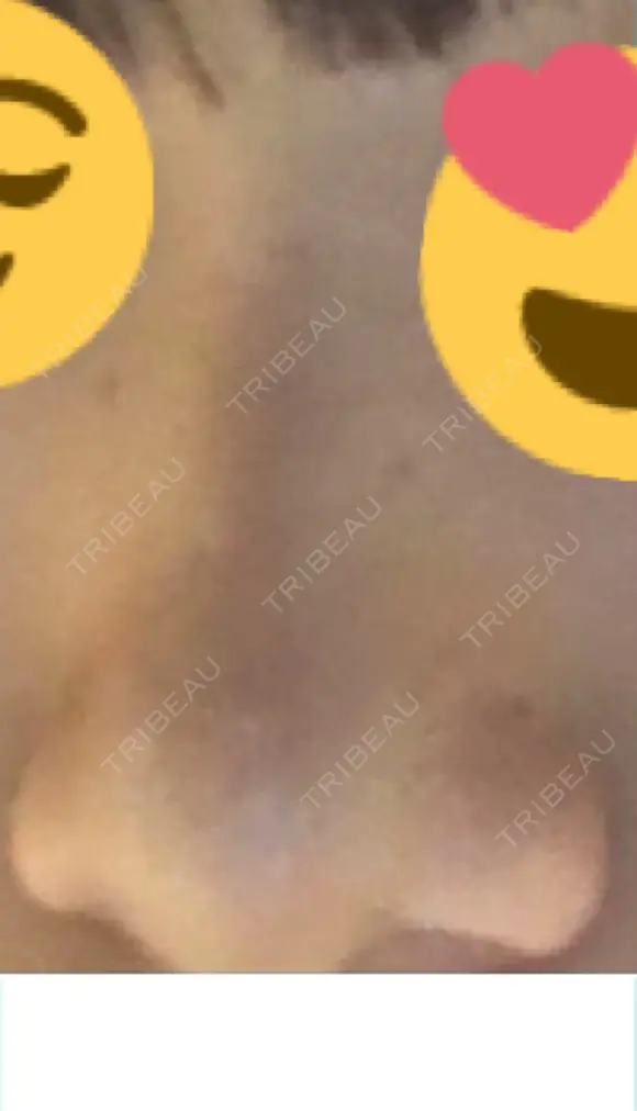 ヒアルロン酸注入（鼻） 新宿ビューティークリニック 新宿院 AFTER メイン用