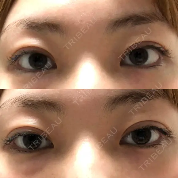 二重切開 松下皮フ形成外科 DAY 51 メイン用