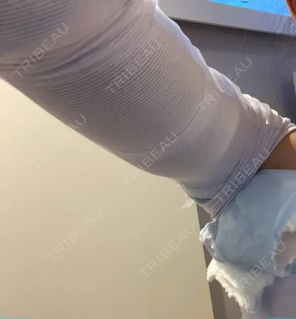 脂肪吸引（二の腕） / その他（ボディ） 銀座マイアミ美容外科 DAY 0 メイン用