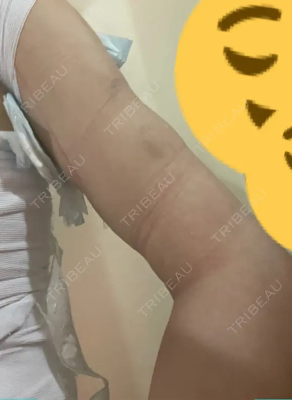 脂肪吸引（二の腕） / その他（ボディ） 銀座マイアミ美容外科 DAY 1 メイン用