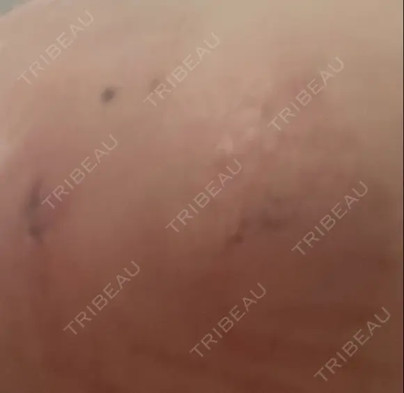 脂肪吸引（二の腕） / その他（ボディ） 銀座マイアミ美容外科 DAY 1 メイン用