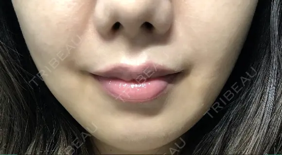 糸リフト EMMA CLINIC（エマクリニック） DAY 7 メイン用