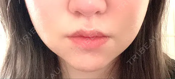 糸リフト / バッカルファット除去 EMMA CLINIC（エマクリニック） DAY 1 メイン用
