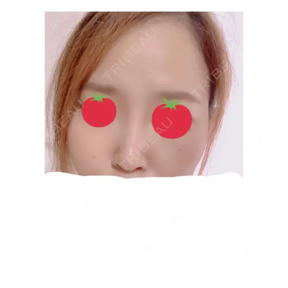 隆鼻術 / 鼻中隔延長（切開） / 軟骨移植 / 鼻尖縮小 しらさぎ形成クリニック 徳島院 DAY 17 メイン用