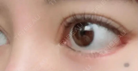 目尻靭帯移動 こいずみ形成クリニック名古屋 DAY 30 メイン用