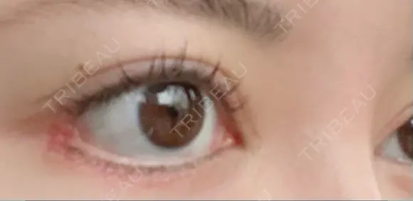 目尻靭帯移動 こいずみ形成クリニック名古屋 DAY 30 メイン用