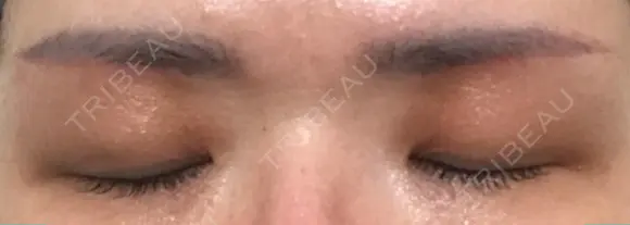 眉下切開 湘南美容クリニック 大阪京橋院 DAY 43 メイン用