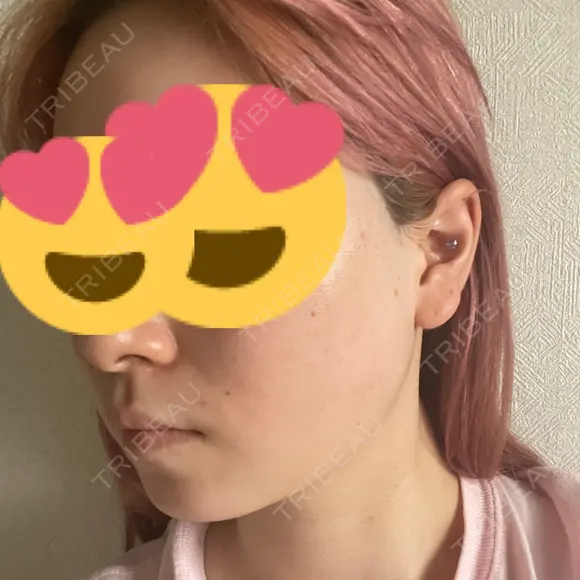 ボトックス（エラ・小顔） 湘南美容クリニック 西宮北口院 DAY 7 メイン用