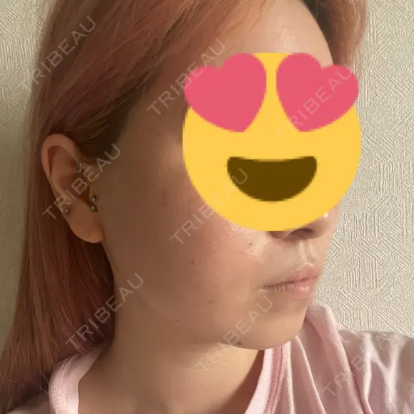 ボトックス（エラ・小顔） 湘南美容クリニック 西宮北口院 DAY 7 メイン用