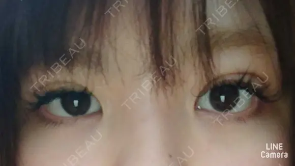 二重埋没 / 上まぶたの脂肪取り 共立美容外科 大宮院 DAY 15 メイン用