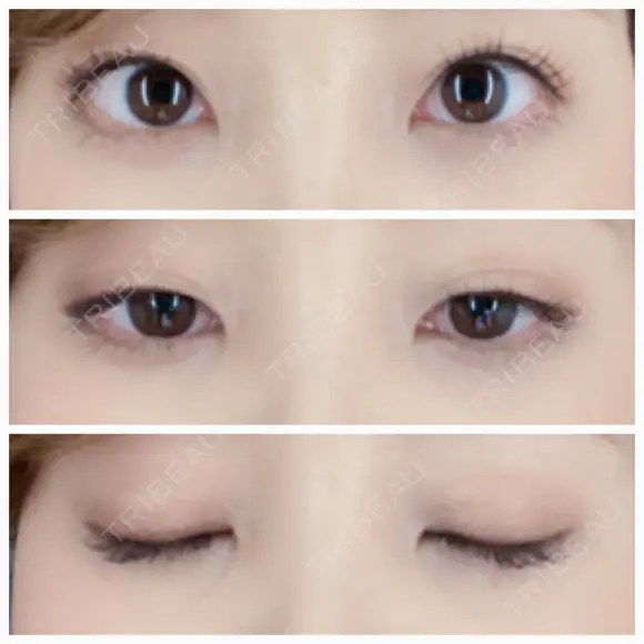 二重埋没 / 眼瞼下垂（切開） / クマ治療 / 下まぶたの脂肪取り THE MEDICAL SALON AFTER メイン用