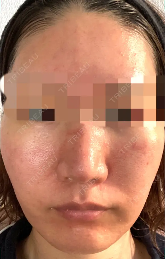 ダーマペン / 毛穴洗浄（ハイドラフェイシャルなど） AURORA CLINIC（オーロラクリニック）新宿院 DAY 2 メイン用