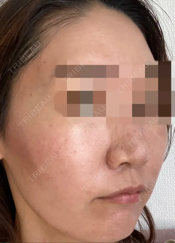 ダーマペン / 毛穴洗浄（ハイドラフェイシャルなど） AURORA CLINIC（オーロラクリニック）新宿院 DAY 2 メイン用