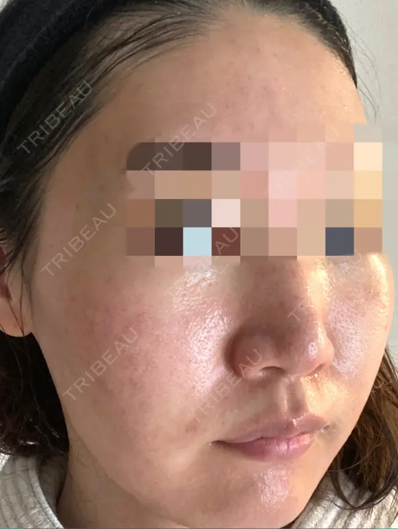 ダーマペン / 毛穴洗浄（ハイドラフェイシャルなど） AURORA CLINIC（オーロラクリニック）新宿院 DAY 3 メイン用