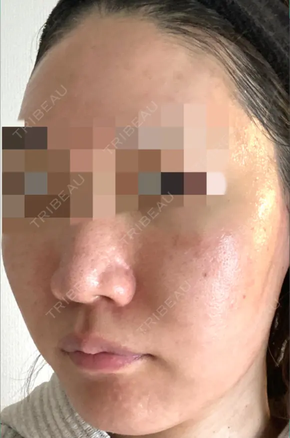 ダーマペン / 毛穴洗浄（ハイドラフェイシャルなど） AURORA CLINIC（オーロラクリニック）新宿院 DAY 3 メイン用