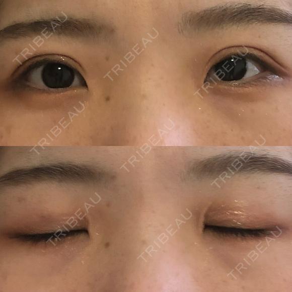 二重切開 城本クリニック 福岡院 AFTER メイン用