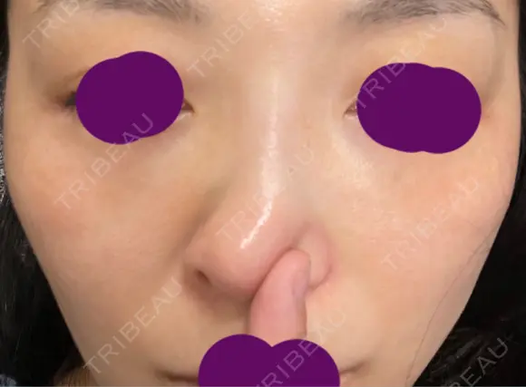 軟骨移植 フェアクリニック川口 DAY 24 メイン用