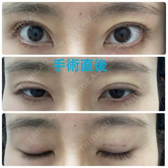 二重埋没 オジスキンクリニック DAY 0 メイン用