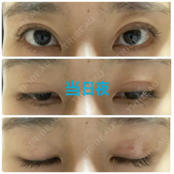 二重埋没 オジスキンクリニック DAY 0 メイン用