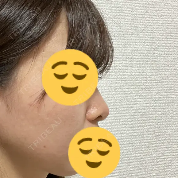 隆鼻術 / 鼻尖縮小 / ヒアルロン酸注入（鼻） 品川美容外科 福岡院 DAY 11 メイン用