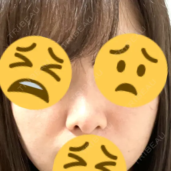 隆鼻術 / 鼻尖縮小 / ヒアルロン酸注入（鼻） 品川美容外科 福岡院 DAY 11 メイン用