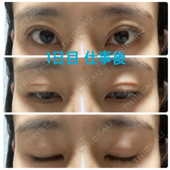 二重埋没 オジスキンクリニック DAY 1 メイン用