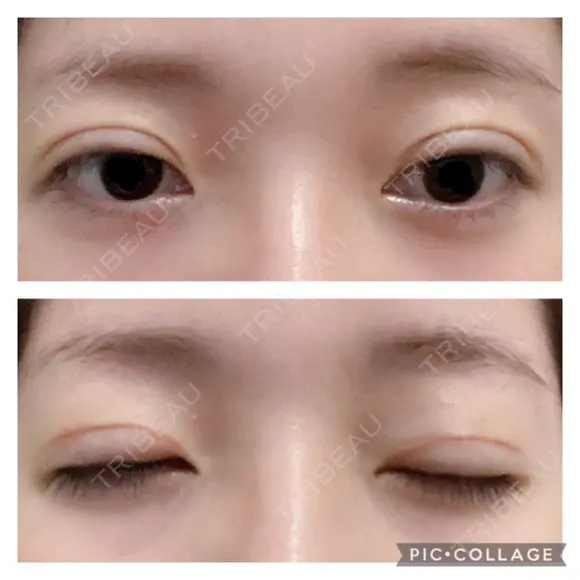 二重切開 松下皮フ形成外科 DAY 13 メイン用