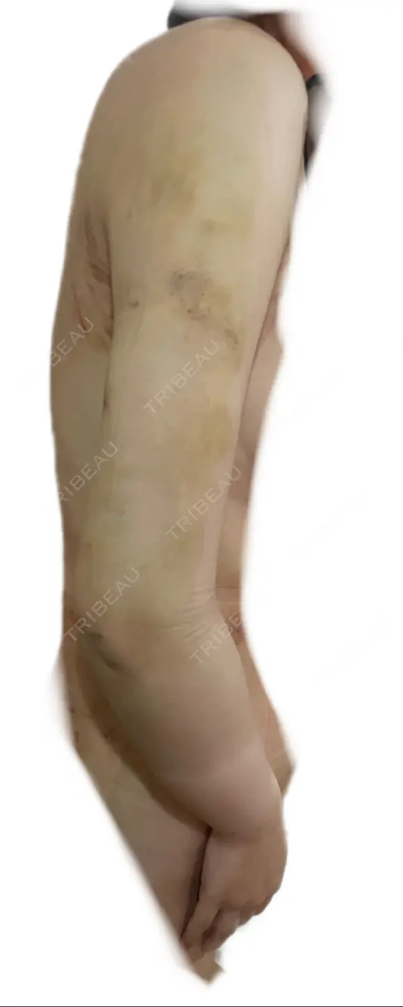 脂肪吸引（二の腕） / その他（ボディ） 銀座マイアミ美容外科 DAY 3 メイン用