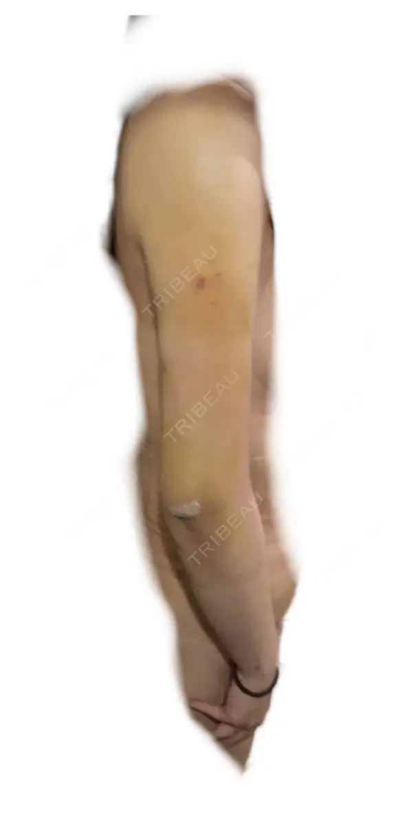 脂肪吸引（二の腕） / その他（ボディ） 銀座マイアミ美容外科 AFTER メイン用