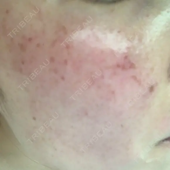 美肌レーザー / シミ取りレーザー たかはし形成外科･美容外科  DAY 44 メイン用