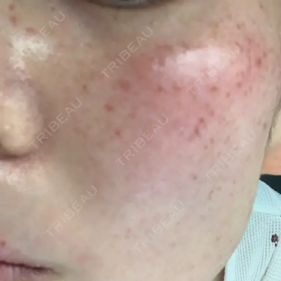 美肌レーザー / シミ取りレーザー たかはし形成外科･美容外科  DAY 44 メイン用